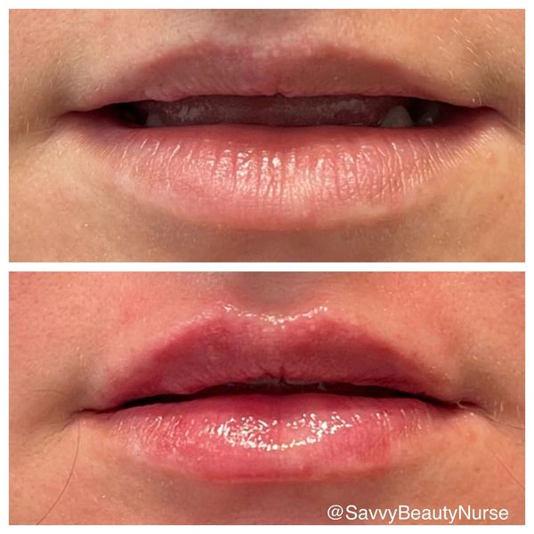 Lip Filler Before and After 6