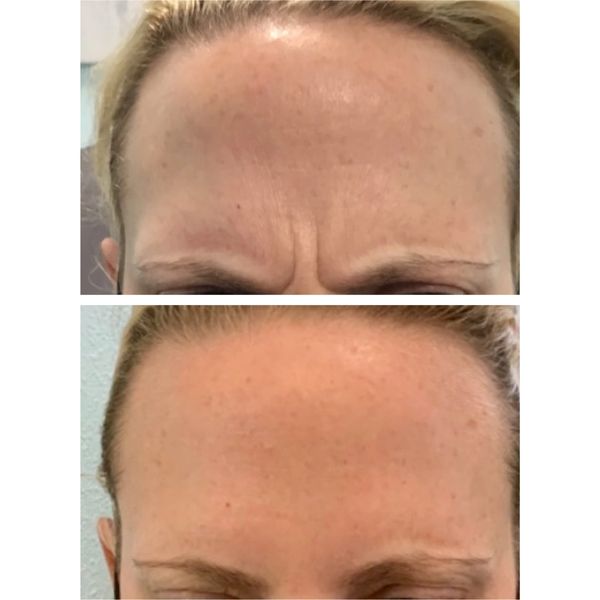 Wrinkle Relaxers Before and After 2