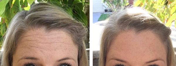 Wrinkle Relaxers Before and After 8