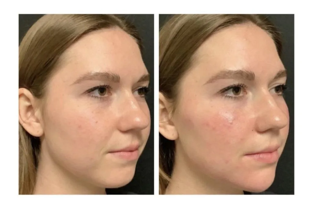 Maximizing the Efficacy of Botox: Understanding Factors and Optimizing Results